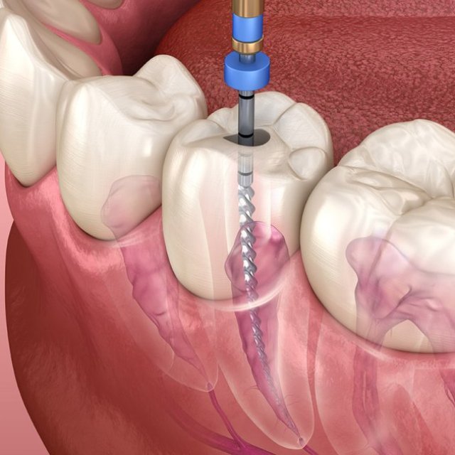Root Canal in Flint, MI