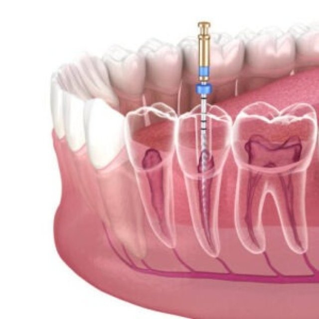 Root Canal Surgery In Oakville | Toothfairydentistry.ca