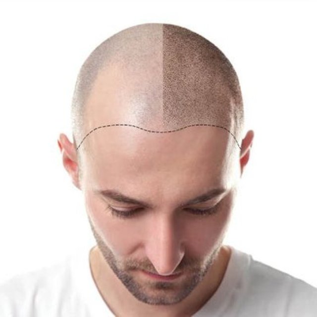 best hair replacement