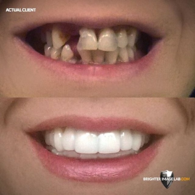 Restore Your Confidence with Expert Teeth Replacement Solutions