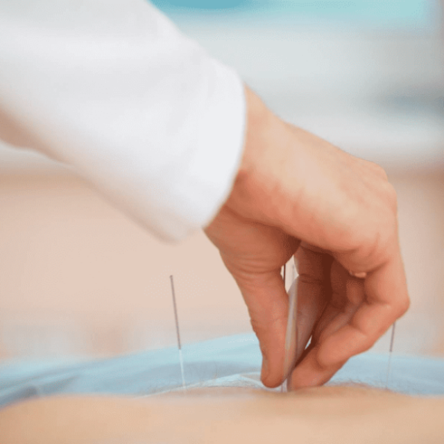 Acupuncture NYC