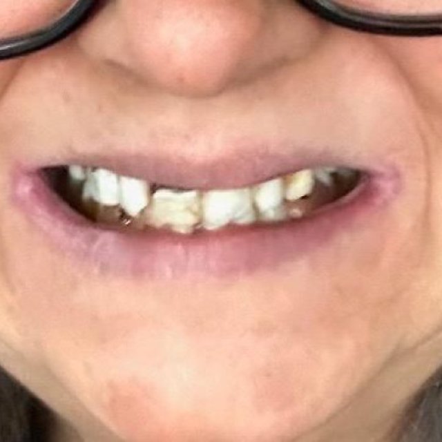 Invisalign In North York | Glenoakdental.ca