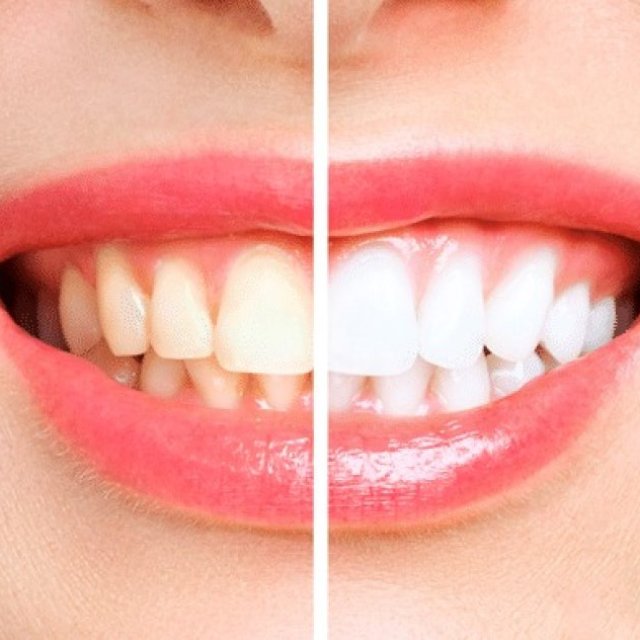 Teeth Whitening in London, Ontario - Brighten Your Smile