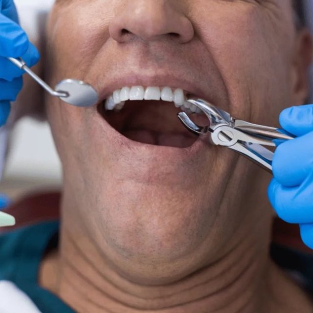 Teeth Extraction Milton | Smilelounge.ca
