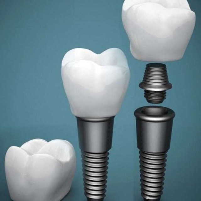 Dental Implants Milton Ontario | Tremainedental.com