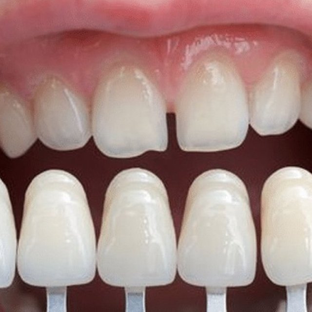 Cosmetic Teeth Surgery for a Dazzling Smile in London