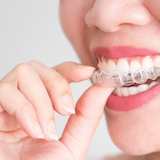 Invisalign in London, Ontario - Straighten Your Smile