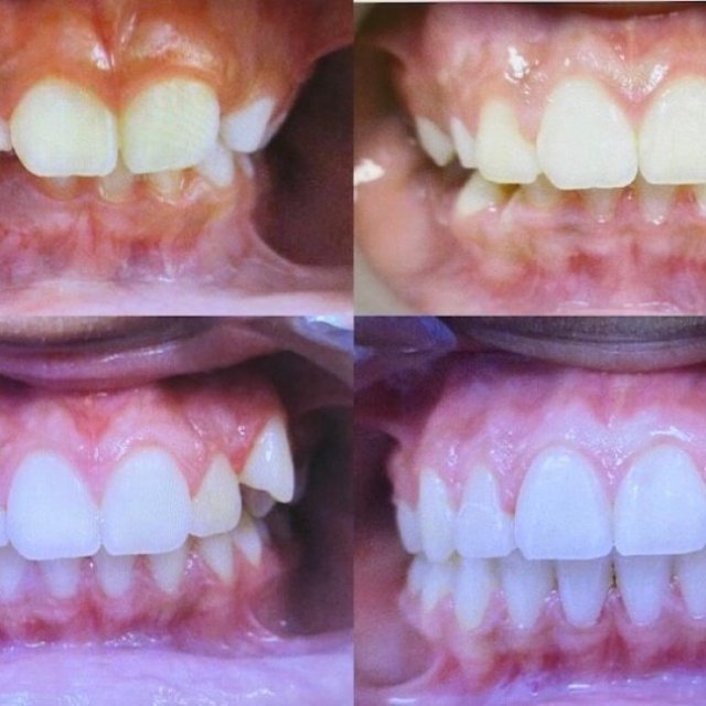 Pasadena Braces