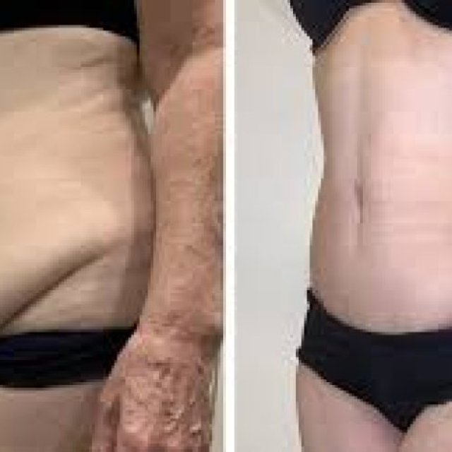 Expert Liposuction & Cosmetic Treatments in Islamabad