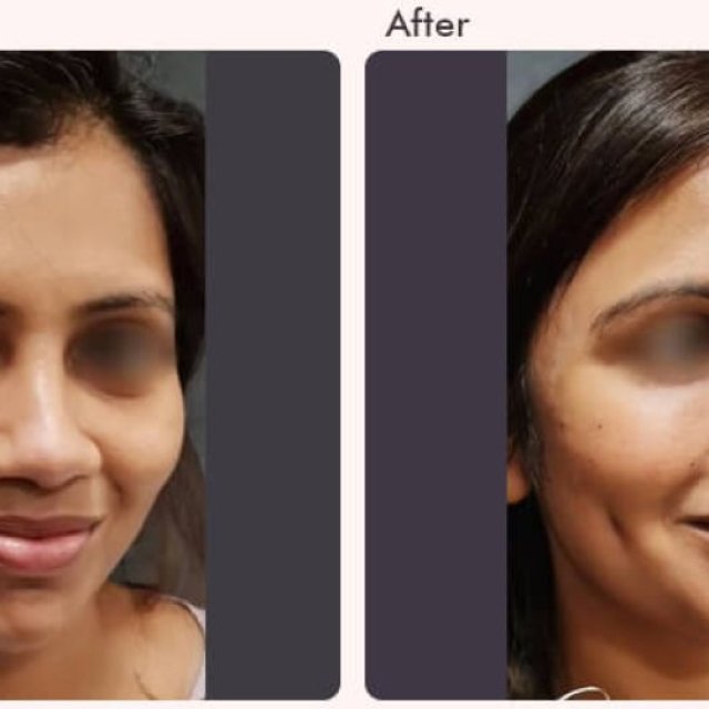 Dimple Creation Surgery Cost in Delhi - Dr Rajat Gupta