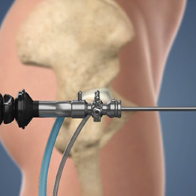Dr. Vijay C. Bose Best Hip Arthroscopy Surgeon in India