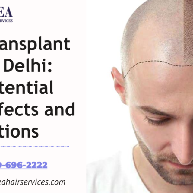 Hair Transplant in Delhi