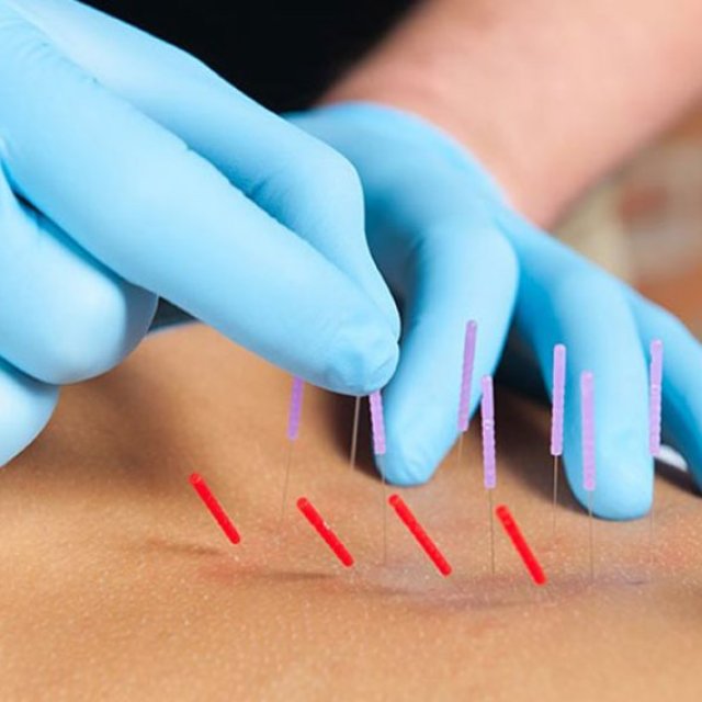 Dry Needling Therapy NYC